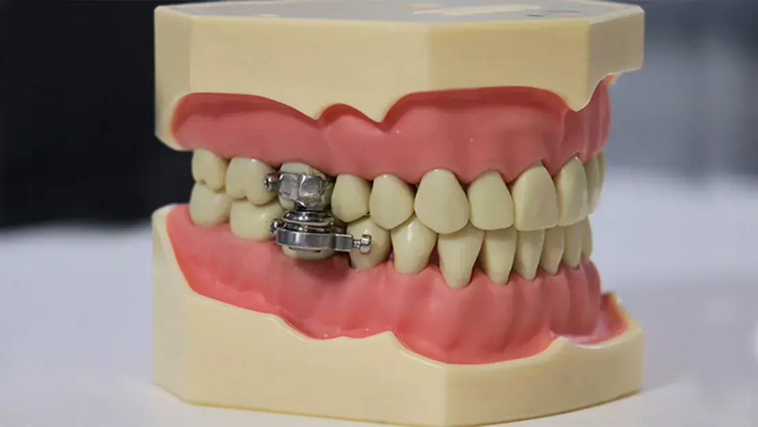 Vídeo: Presentan el «primer dispositivo del mundo para adelgazar» cerrando los dientes con un ‘candado’