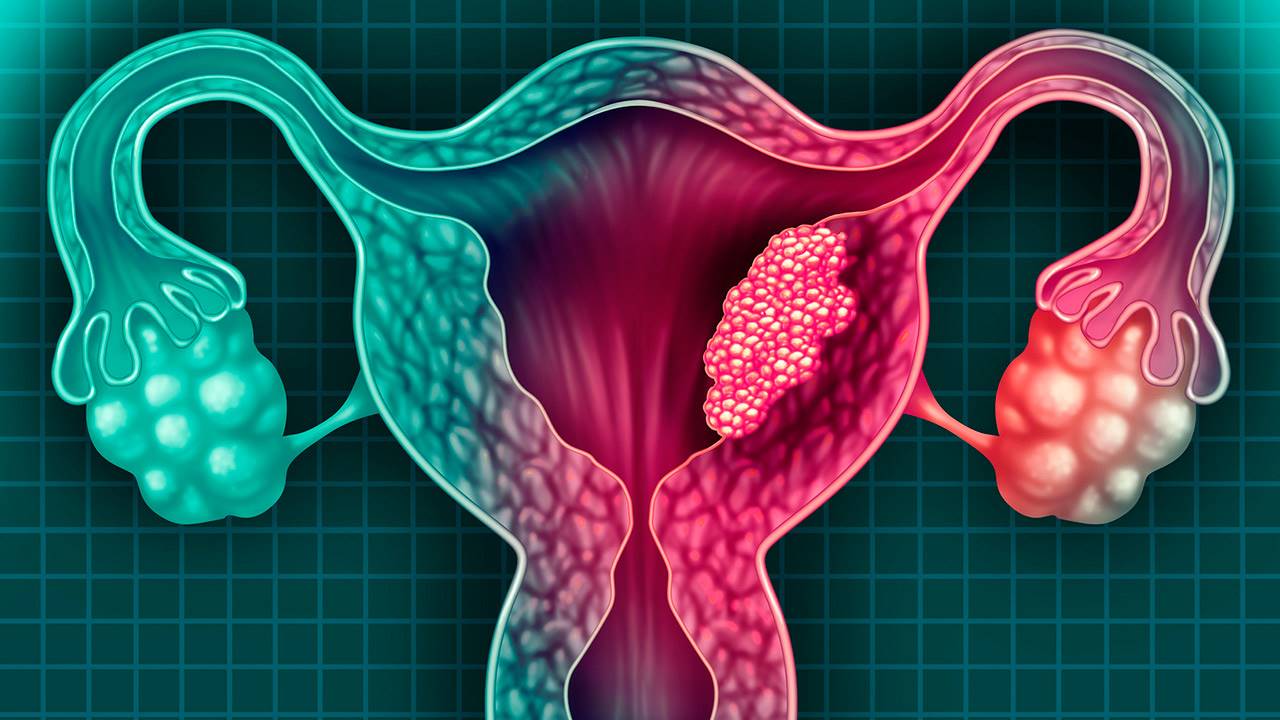 Disminuye el cáncer de cérvix por el VPH pero aumentan otros relacionados