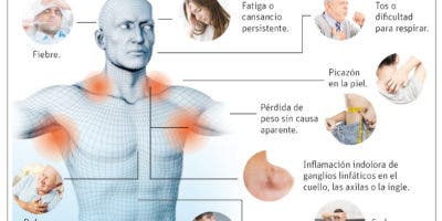 El linfoma, un cáncer que es más común en hombres que en mujeres