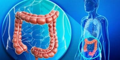 En  cáncer intestinal, pólipo serrado es difícil de detectar