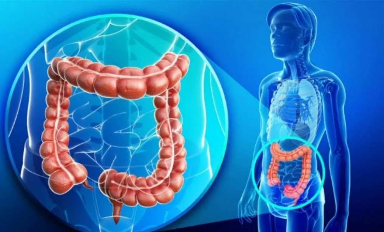 En  cáncer intestinal, pólipo serrado es difícil de detectar