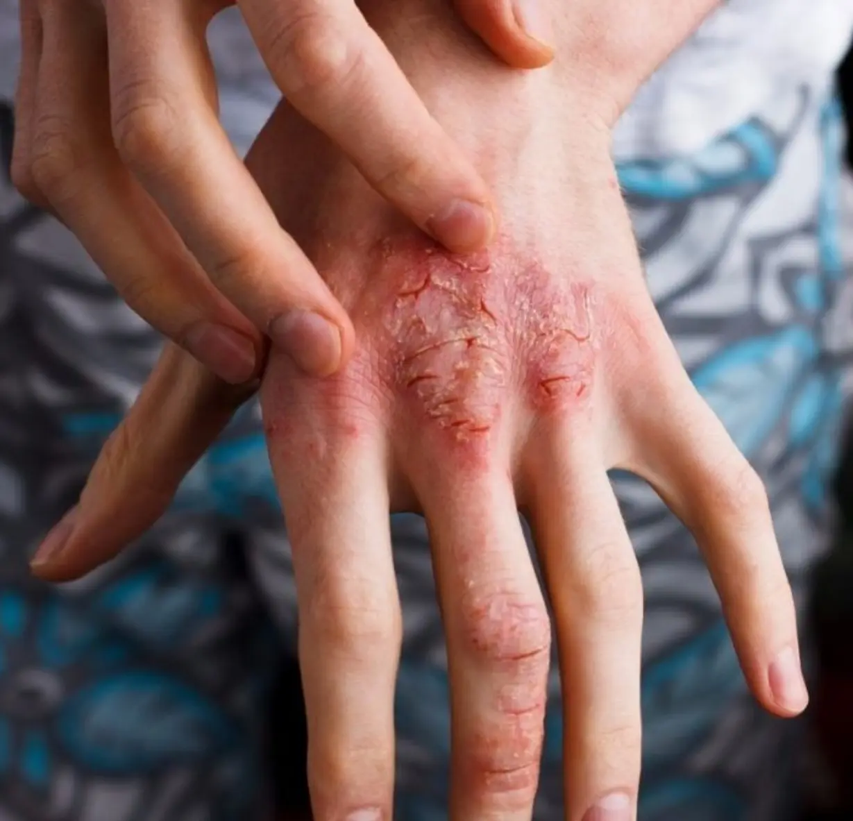 La dermatitis atópica sí es controlable en los niños y adolescentes