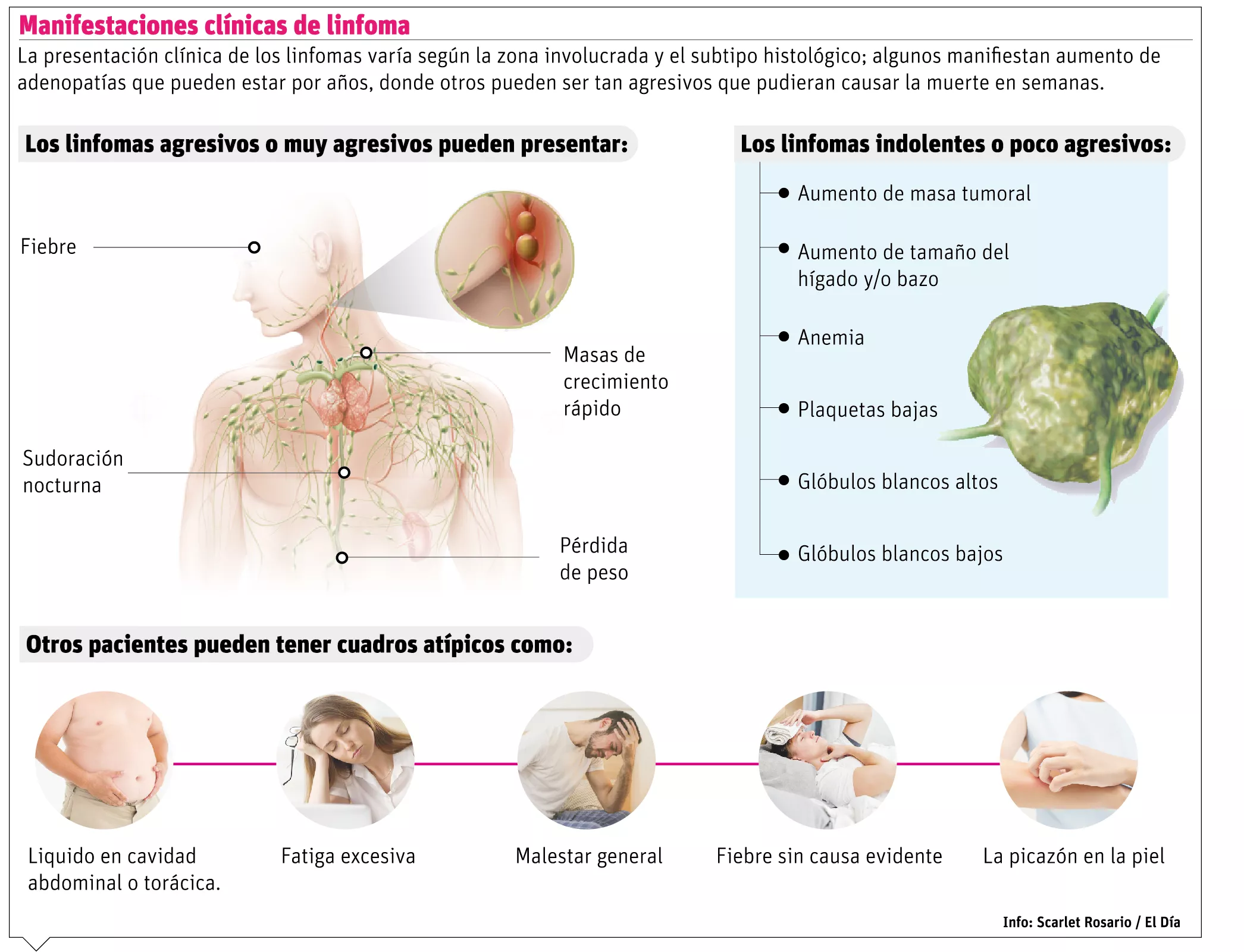 Linfoma, un cáncer que no discrimina la edad, raza ni nivel socioeconómico