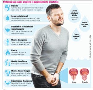 Hiperplasia prostática puede ocasionar daños en la vejiga, las vías urinarias y los riñones