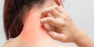 Dermatóloga llama estar alerta ante lesiones y alteraciones en la piel