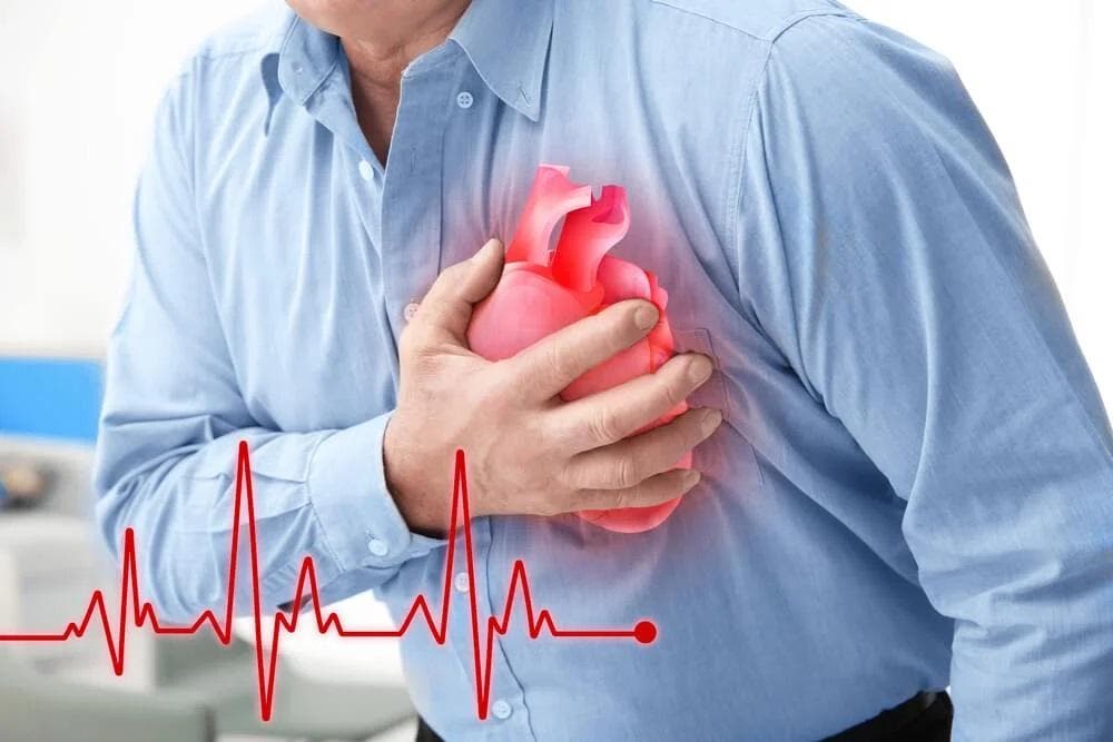 ¿Cómo identificar el infarto?
