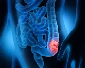 80% muertes por cáncer de colon se pueden evitar, sociedad médica va por ello