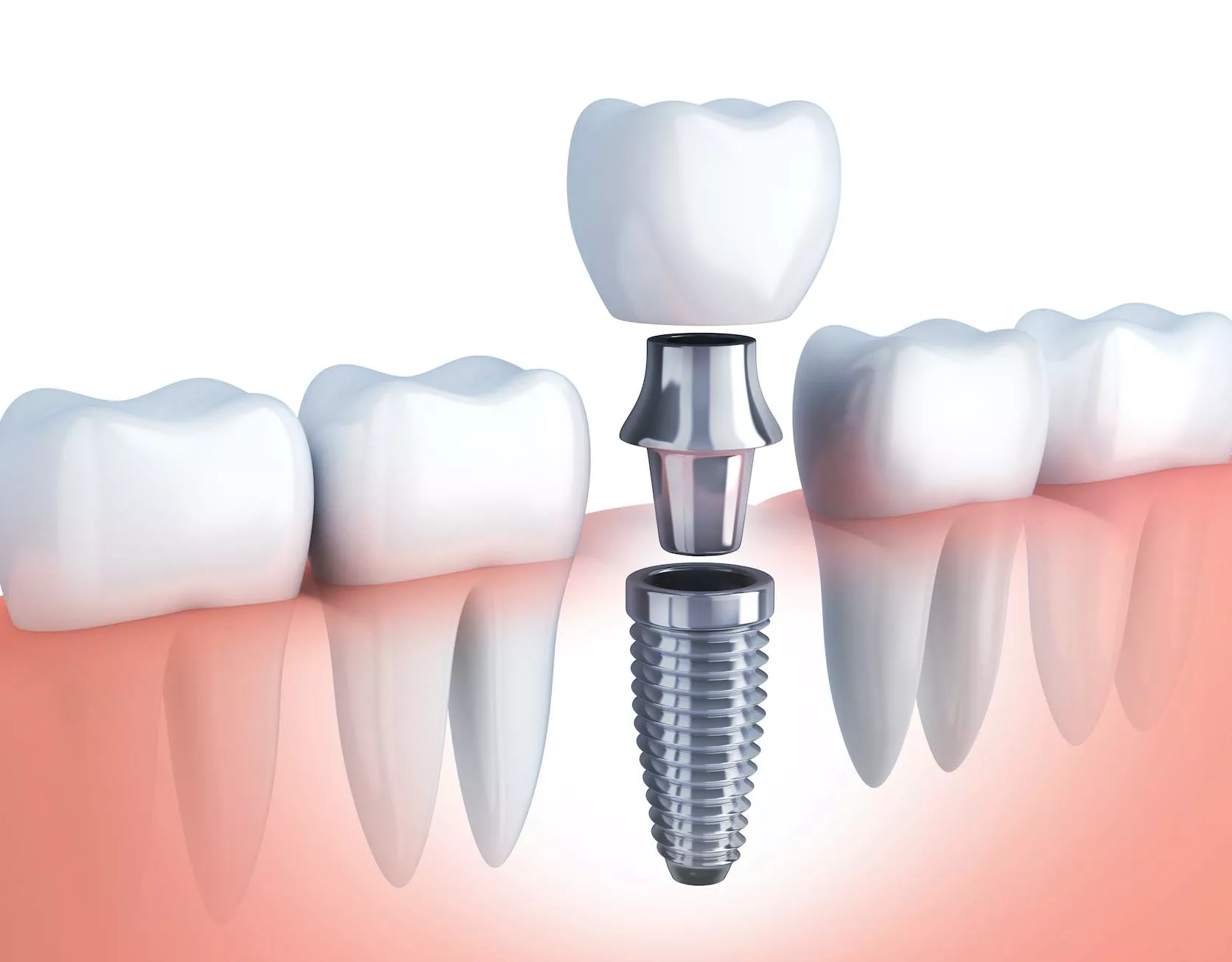 Salud Pública mantiene suspensión de jornadas implantes dentales no cuenten con la debida habilitación