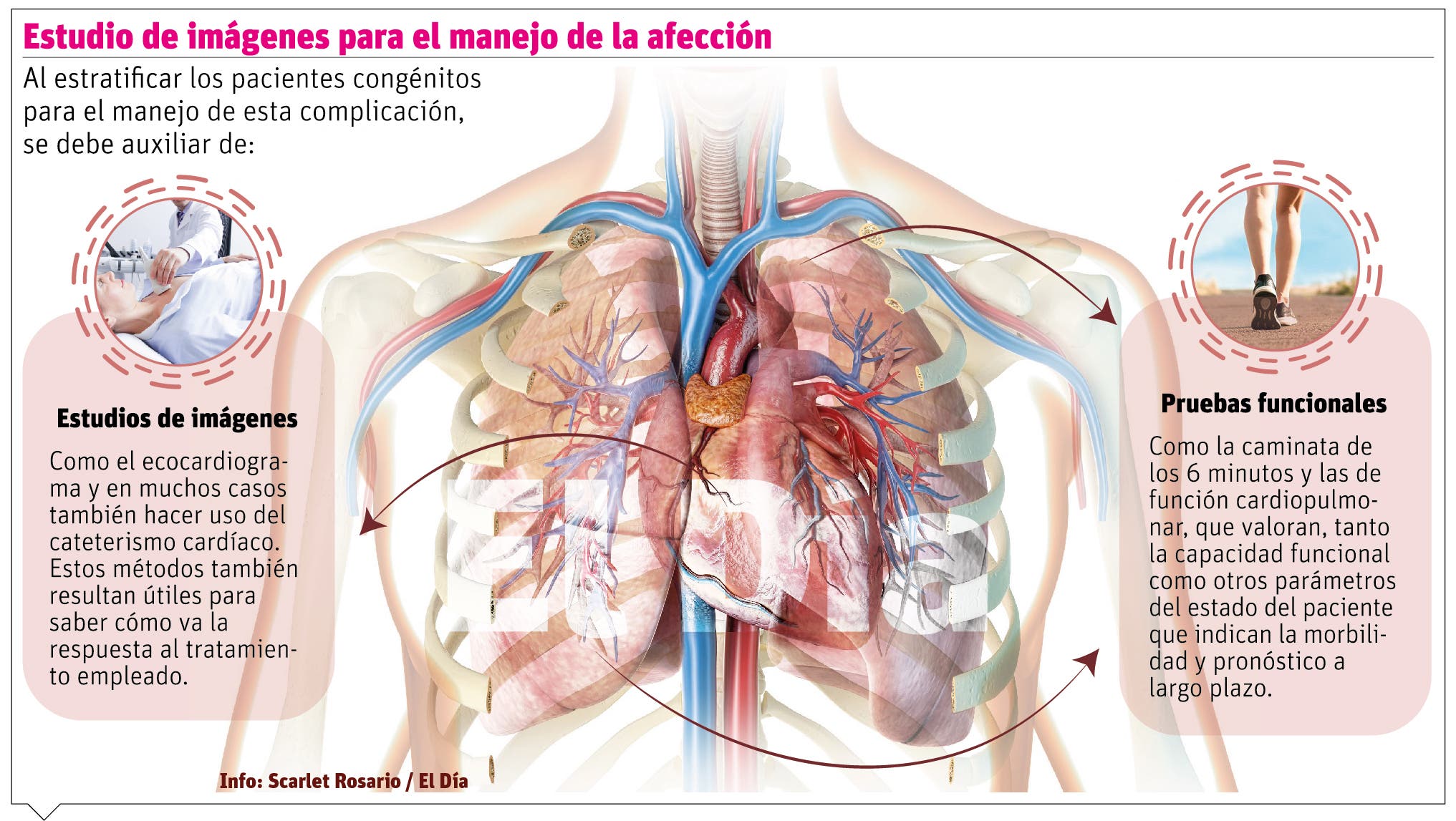 Hipertensión pulmonar  condición que puede afectar también al corazón