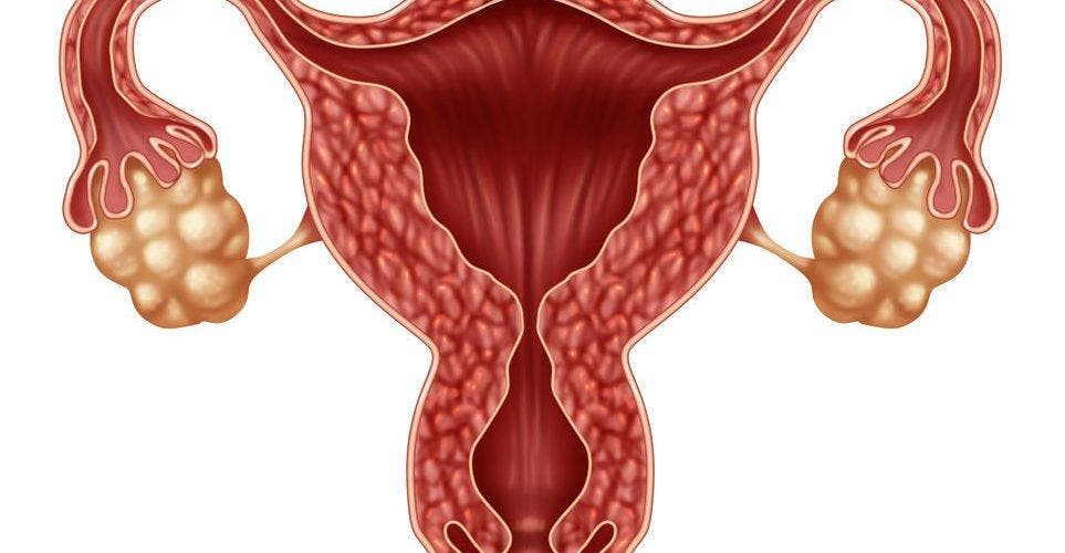 Detección tardía Síndrome Ovario Poliquístico podría causar infertilidad en las mujeres