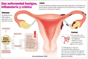 Tratamiento  endometriosis se  recomienda personalizado