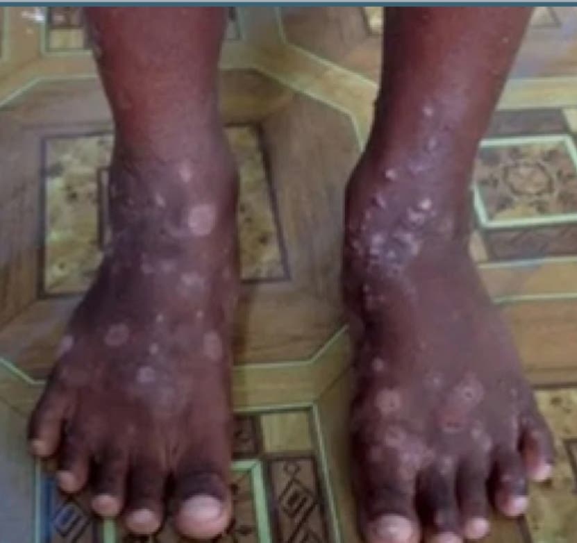 Dermatólogos llaman a la población a no alarmarse por infección piel en Haití
