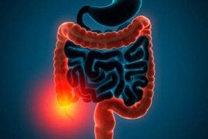 Trasplantes de heces fecales podrían mejorar pacientes con colitis ulcerosa