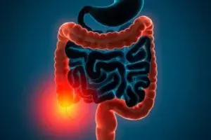 Trasplantes de heces fecales podrían mejorar pacientes con colitis ulcerosa