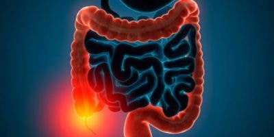 Trasplantes de heces fecales podrían mejorar pacientes con colitis ulcerosa