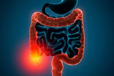 Trasplantes de heces fecales podrían mejorar pacientes con colitis ulcerosa