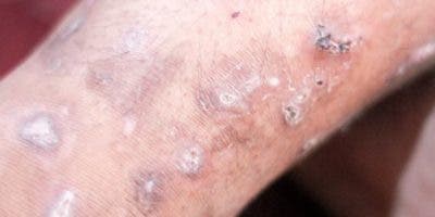 Haití advierte sobre una rara y «altamente contagiosa» enfermedad de la piel