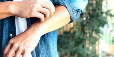 Viruela del mono: cómo saber si tienes esta u otra enfermedad