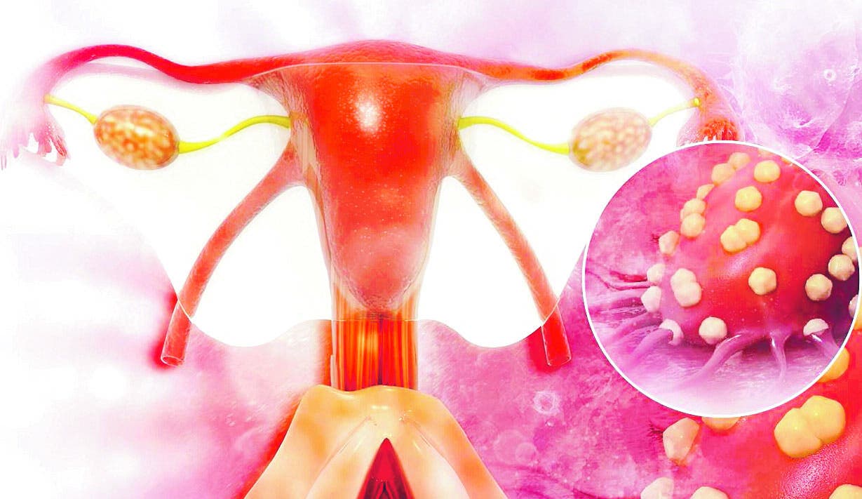Más de 200 mil mueren al año por cáncer de ovario