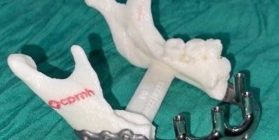 Especialistas realizan novedosa prótesis bucal