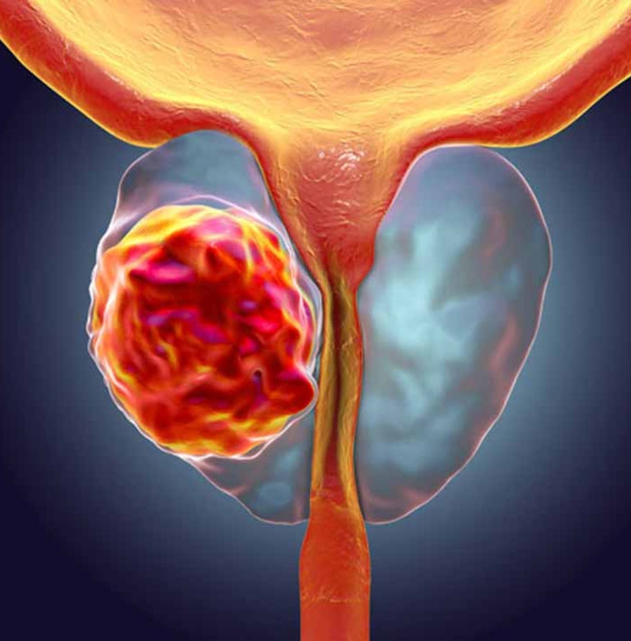 ¡Chequéate! Conocer factores de riesgo, clave  detección cáncer próstata