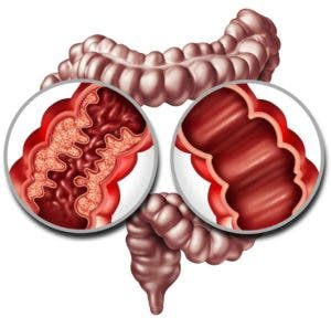 Cómo enfrentar desafíos de la colitis ulcerosa