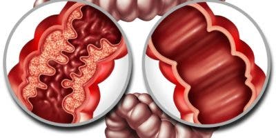 Cómo enfrentar desafíos de la colitis ulcerosa