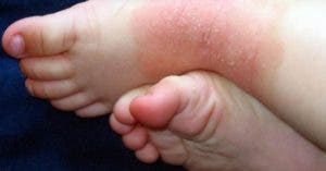 Síntomas afectan el descanso de al menos 65 % de niños con dermatitis atópica