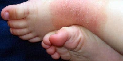 Síntomas afectan el descanso de al menos 65 % de niños con dermatitis atópica