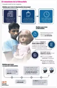 La hidrocefalia e hipertensión intracraneal, causas y tratamientos