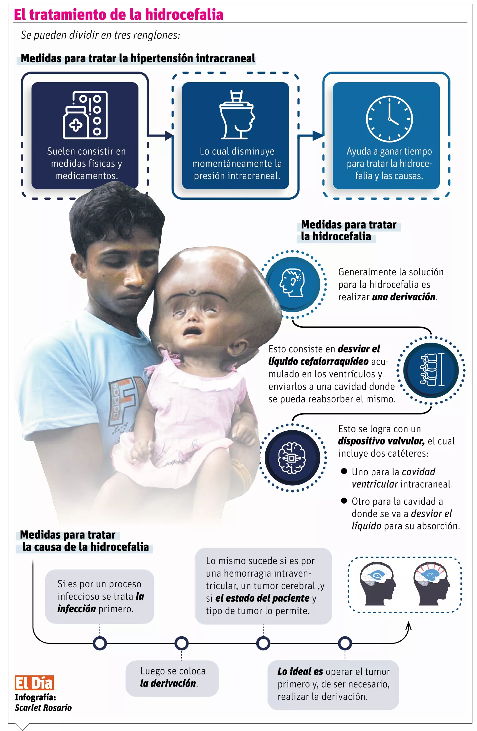 La hidrocefalia e hipertensión intracraneal, causas y tratamientos