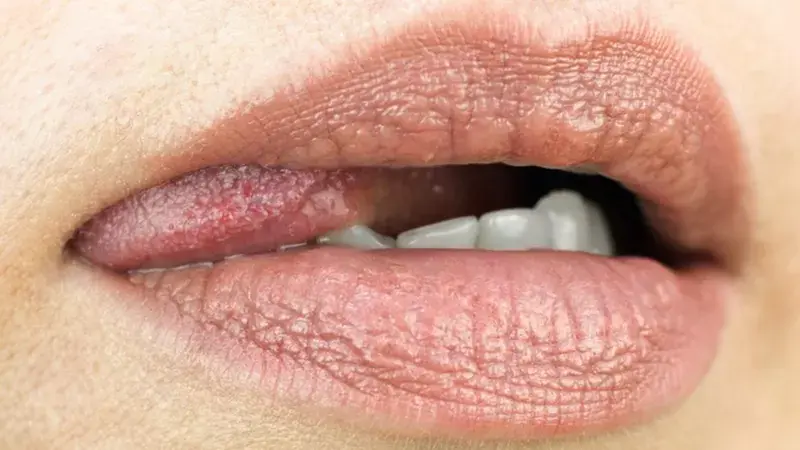 Las enfermedades que pueden transmitirse durante el sexo oral sin preservativo