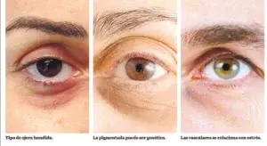 Origen de la ojeras es multifactorial y a veces dificulta éxito terapéutico