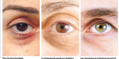 Origen de la ojeras es multifactorial y a veces dificulta éxito terapéutico