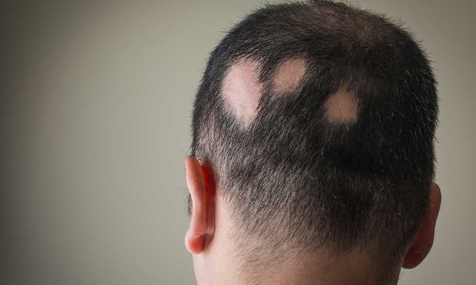 La alopecia, pérdida anormal de cabello que se trata según la causa