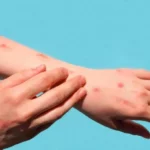 Nueva York emite alerta sanitaria tras detectarse el primer caso de Mpox