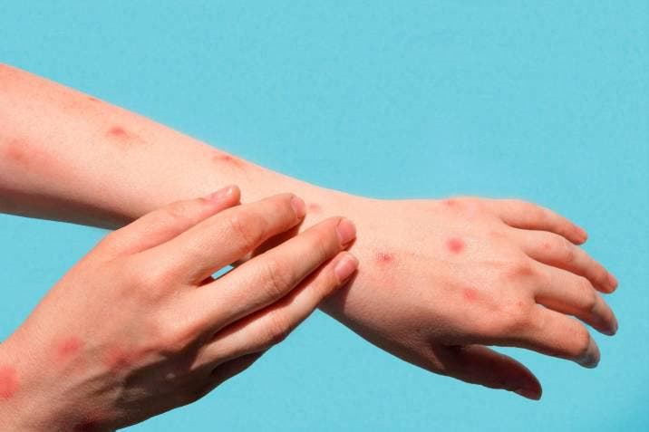 Salud Pública notifica dos nuevos casos de la viruela símica y van 31