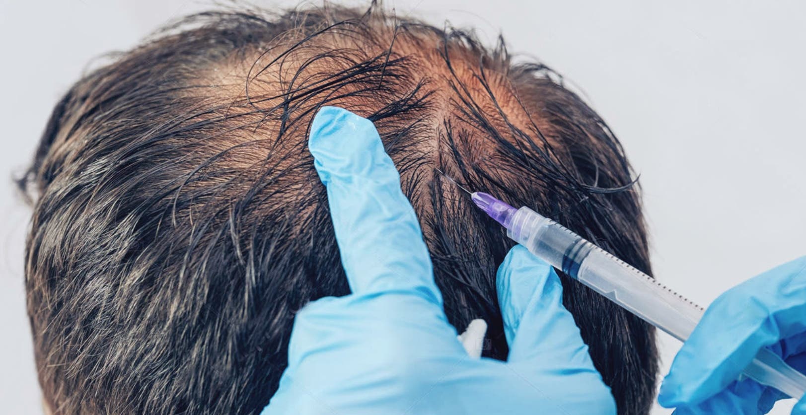 La mesoterapia capilar detiene caída del cabello