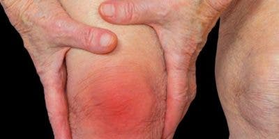 Diferencias entre  artritis reumatoide y artritis psoriásica