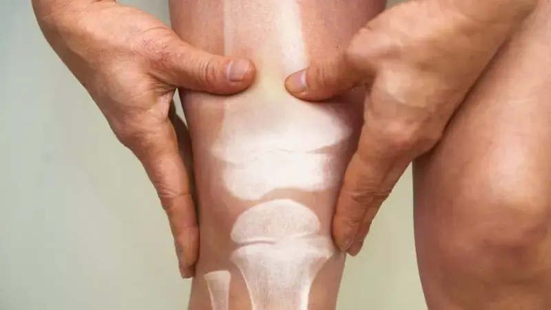 Osteoporosis masculina: la enfermedad que causa fracturas a miles de hombres en el mundo