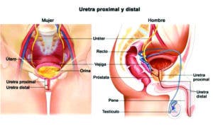 Causa más frecuente de uretritis es infecciosa