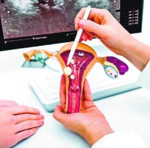 Miomatosis uterina, tumoraciones que se presenta hasta en 70% de ...