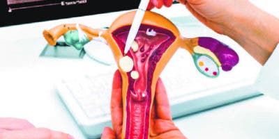 Miomatosis uterina, tumoraciones que se presenta hasta en 70% de  las mujeres