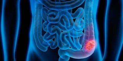 Oncóloga alerta por aumento cáncer de colon en los jóvenes