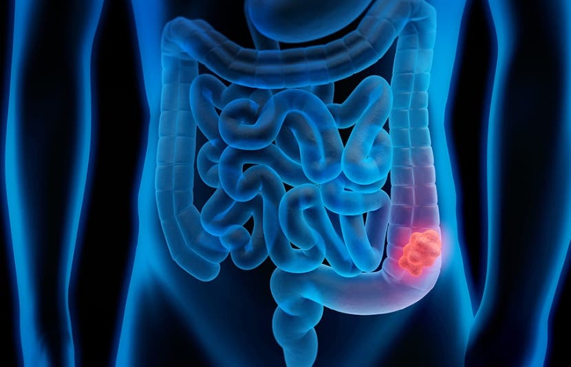 Oncóloga alerta por aumento cáncer de colon en los jóvenes