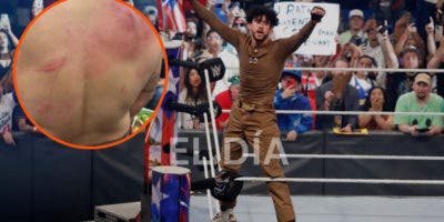 Bad Bunny muestra su espalda con arañazos y hematomas tras pelea en la WWE