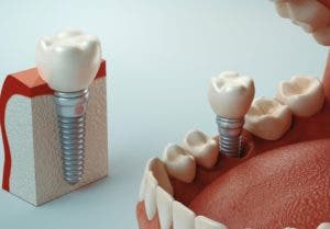 Implantes dentales, una alternativa  exitosa para reemplazar piezas