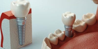 Implantes dentales, una alternativa  exitosa para reemplazar piezas