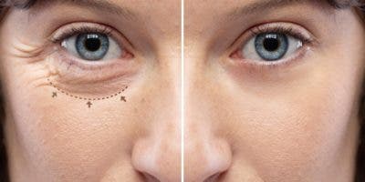 Blefaroplastia mejora el campo visión y exceso piel