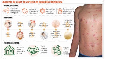 No hay que alarmarse por casos de varicela, dice Salud Pública